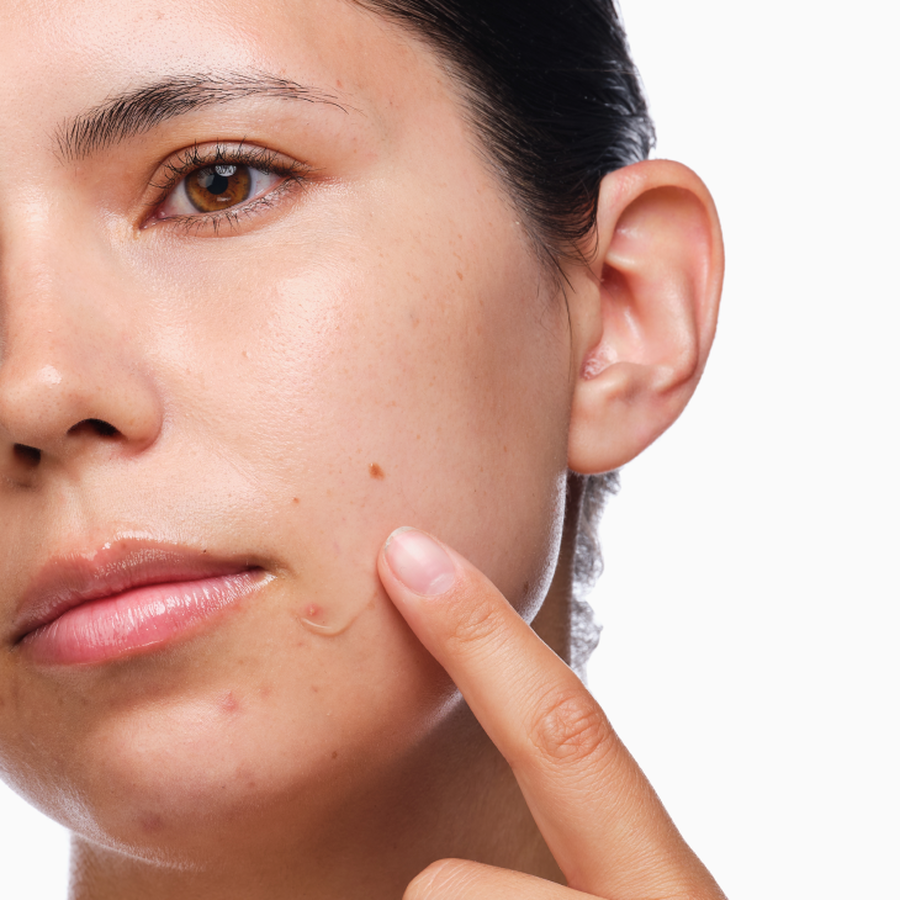 the-acne-set-q8 rdn-the-acne-set-application.png