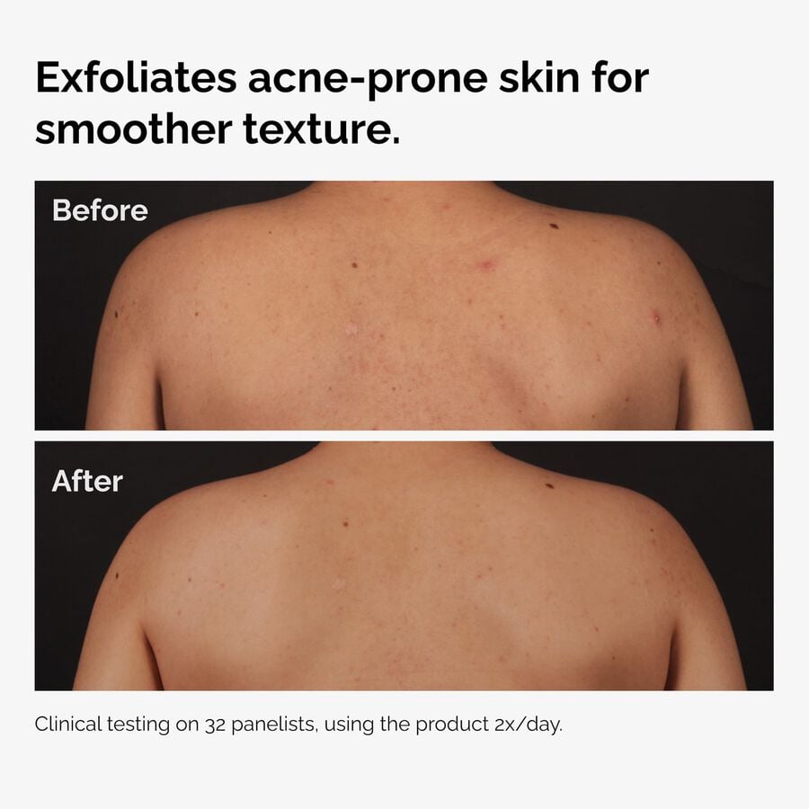 the-body-care-collection-t8 ord-salicylic-acid-body-serum-before-after-graphic-NA.jpg