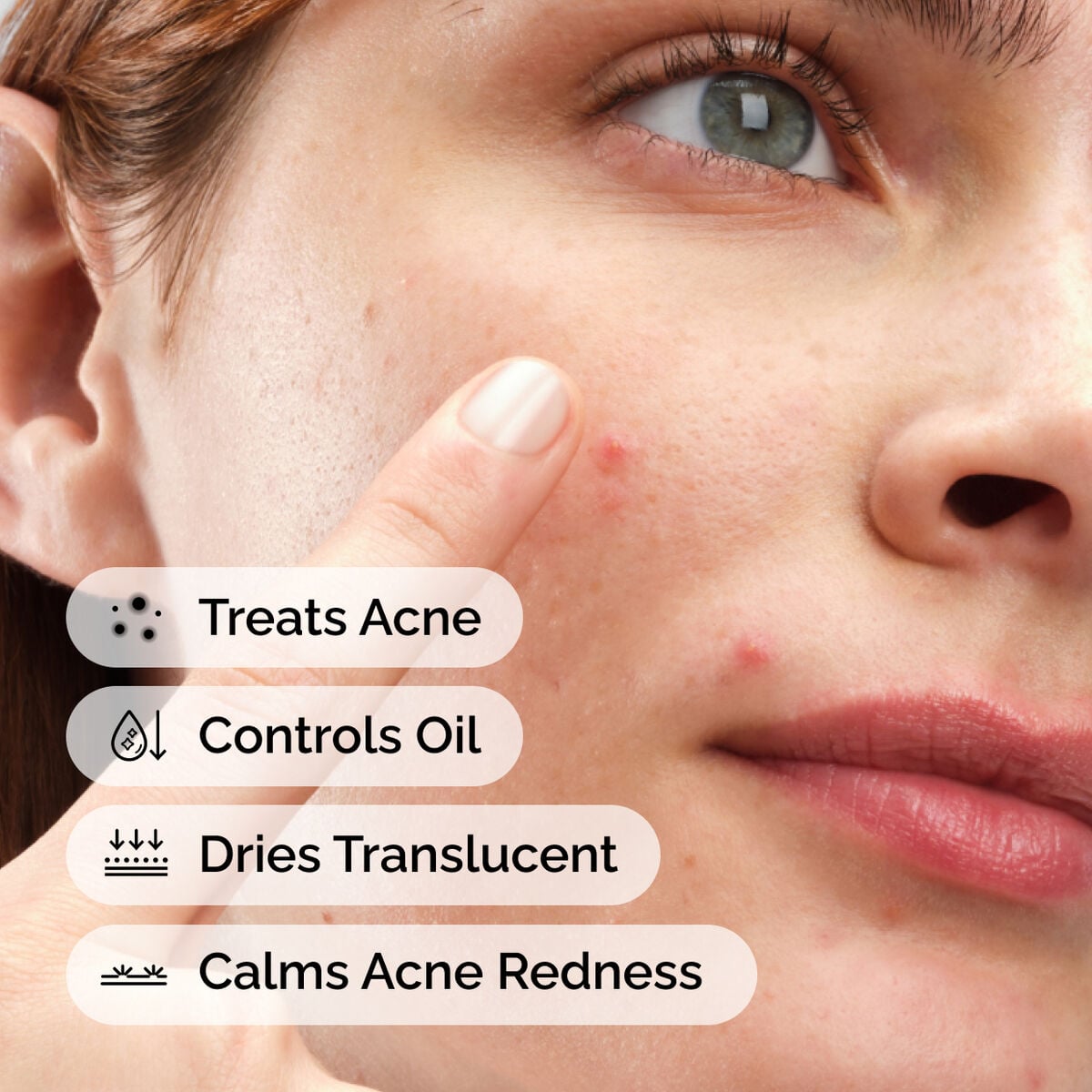 sulfur-10-powder-to-cream-concentrate-c0 ord-sulfur-10pct-powder-to-cream-concentrate-model-application-with-benefits-acne.jpg
